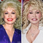 Dolly Parton before and after plastic surgery 04