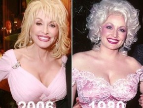 Dolly Parton before and after plastic surgery 05