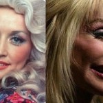 Dolly Parton before and after plastic surgery 06