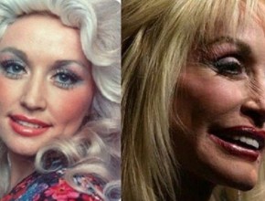 Dolly Parton before and after plastic surgery 06