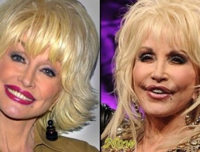 Dolly Parton before and after plastic surgery 07
