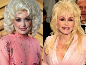 Dolly Parton before and after plastic surgery 08