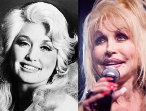 Dolly Parton before and after plastic surgery 10