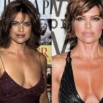 Lisa Rinna before and after breast augmentation