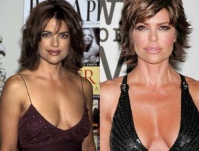 Lisa Rinna before and after breast augmentation