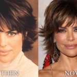 Lisa Rinna before and after using Botox 02