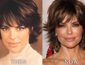 Lisa Rinna before and after using Botox 02