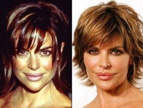 Lisa Rinna before and after using Botox