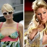 Paris Hilton before and after breast augmentation