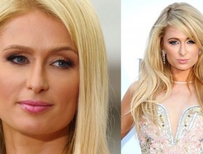 Paris Hilton before and after plastic surgery 01