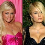 Paris Hilton before and after plastic surgery