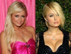 Paris Hilton before and after plastic surgery