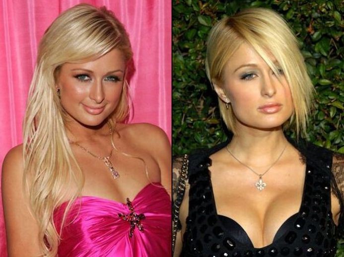 Paris Hilton before and after plastic surgery