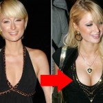 Paris Hilton plastic surgery breast augmentation