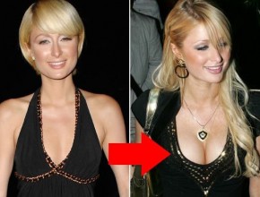 Paris Hilton plastic surgery breast augmentation