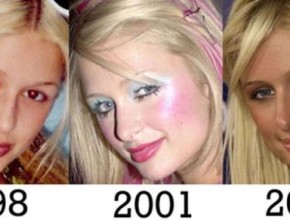 Paris Hiltonplastic surgery transformations