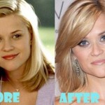 Reese Witherspoon before and after plastic surgery 03