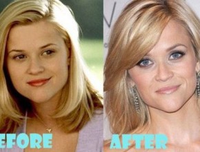 Reese Witherspoon before and after plastic surgery 03