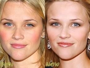 Reese Witherspoon before and after plastic surgery 04