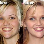 Reese Witherspoon before and after plastic surgery 05
