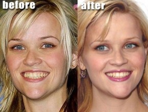 Reese Witherspoon before and after plastic surgery 05
