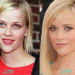 Reese Witherspoon before and after plastic surgery 06