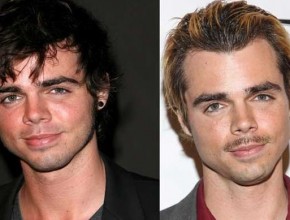 Reid Ewing before and after plastic surgery 03