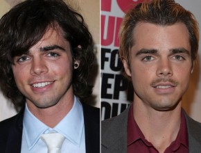 Reid Ewing before and after plastic surgery