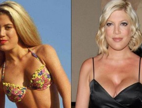 Tori Spelling before and after plastic surgery