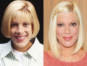 Tori Spelling before and after plastic surgery 02