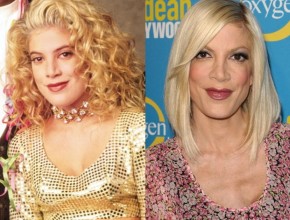 Tori Spelling before and after plastic surgery 03