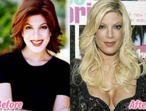 Tori Spelling before and after plastic surgery 04