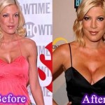 Tori Spelling before and after plastic surgery 06