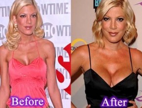 Tori Spelling before and after plastic surgery 06