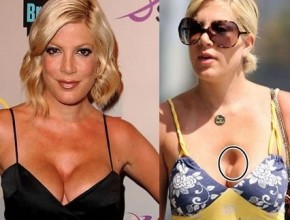 Tori Spelling before and after plastic surgery 08
