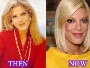 Tori Spelling before and after plastic surgery 09