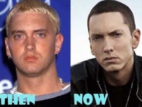 Eminem before and after plastic surgery