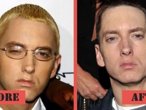 Eminem before and after plastic surgery 04