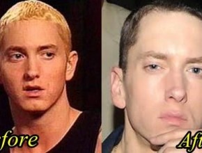 Eminem before and after plastic surgery 05