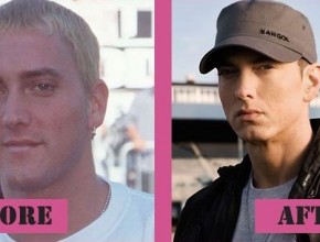 Eminem before and after plastic surgery 06