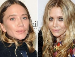 Mary-Kate Olsen before and after plastic surgery 03