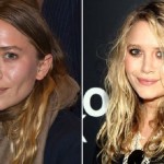 Mary-Kate Olsen before and after plastic surgery