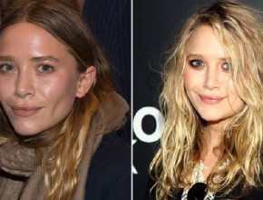 Mary-Kate Olsen before and after plastic surgery