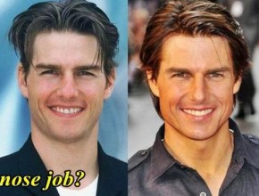 Tom Cruise before and after nose job