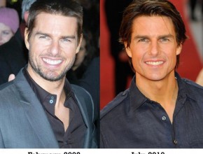 Tom Cruise before and after plastic surgery