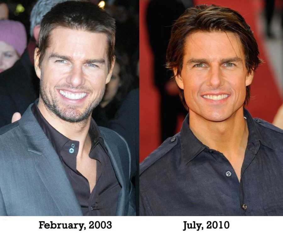 Tom Cruise before and after plastic surgery