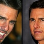 Tom Cruise before and after plastic surgery 02