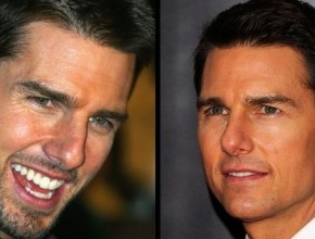 Tom Cruise before and after plastic surgery 02