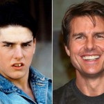 Tom Cruise before and after plastic surgery 03