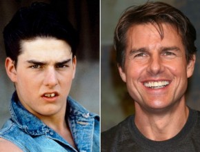 Tom Cruise before and after plastic surgery 03